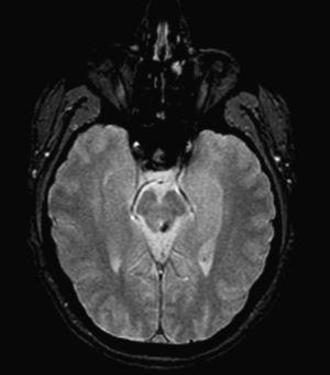 Axial T2-weighted MR image*. Traces of haemosiderin from the old haemorrhage in the left inferior colliculus of the midbrain.