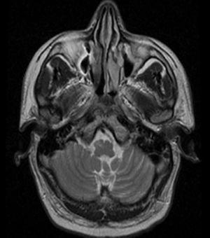 Axial T2-weighted MR image. Hyperintensity in the right anterolateral region of the medulla oblongata, with an increase in volume and changes in the shape of that structure.