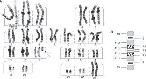 (A) G-banding karyotype showing an extra chromosome derived from chromosome 15 (arrow). (B) Ideogram of the extra chromosome, identifying breakpoints.