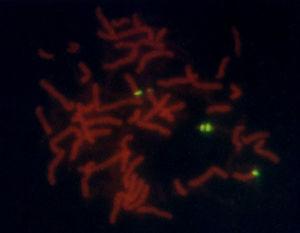 FISH image with centromeric probe specific to chromosome 15 and nuclei in metaphase. Note the 2 green signals on the derived chromosome, plus one in each centromere of the normal copies of chromosome 15.