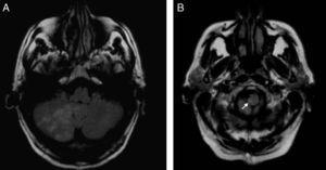 MRI: axial slices, FLAIR sequence. Ischaemic lesion in right cerebellar hemisphere (A), extending to the cervical region of the spinal cord (B).