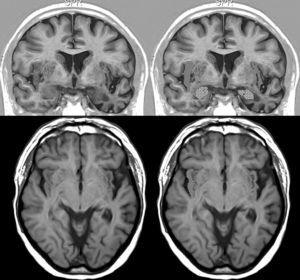 Brain MRI in a patient with FTD and bradycardia. Male patient aged 67 with FTD-semantic dementia in an intermediate stage and a heart rate of 56bpm. Marked atrophy of the left temporal lobe. Above: coronal inversion recovery image; below, axial FLAIR sequence. On the right side, the striped area marks the insular cortex and the dotted area marks the amygdala.