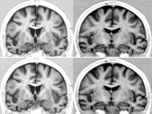 Brain MRI in a patient with FTD and bradycardia. Female patient aged 65 with a 3-year history of FTD-behavioural variant. Readings of 39 and 51bpm in 2 consecutive consultations. Coronal inversion recovery sequences. Note the marked atrophy of the right temporal lobe. In the lower section, the dotted area marks the amygdala and the striped area marks the insular cortex.