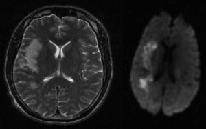 MRI in T2 sequences (left) and DWI sequences (right) showing infarct in the right temporoparietal territory.