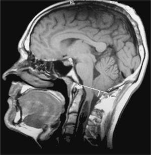 Magnetic resonance image (T1 weighted sagittal sequence) in patient with CM1 presenting herniation of the cerebellar tonsils 9mm below the foramen magnum.