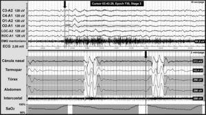Central apnoea in a patient with Chiari malformation type 1. Night-time polysomnography record showing central apnoea (shown in grey bands). The grey line at the end of the respiratory event (arrow) indicates the onset of the cortical microarousal. This can be seen in the EEG channel results with a different time scale. The lower part of the figure shows the decrease in oxygen saturation secondary to apnoea.