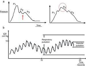 (a) Graph presenting the cardiac wave of intracranial pressure (ICP). The image on the left shows a non-pathological recording; the arrow points to the dicrotic notch. The image on the right shows a pronounced P2 wave in situations of low distensibility. (b) Pulse waveform of ICP.