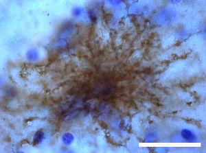 Aquaporin 4 (AQP4) is a protein expressed by astrocytes which regulates water transport. It plays a very important role in neuroinflammation. Immunohistochemical stain for AQP4 showing an astrocyte in an area adjacent to an ischaemic penumbra. Bar=30μm.