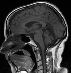 Case 2: Brain MRI scan, sagittal T1-weighted sequence displaying vermian atrophy.