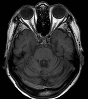 Case 3: Brain MRI scan, sagittal T1-weighted sequence displaying atrophy of the vermis and cerebellar hemispheres.