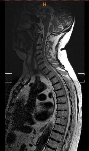 Spinal MRI: sagittal sequence showing a large ischaemic lesion.