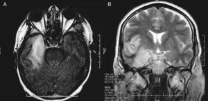 MRI resulting in probable diagnosis of encephalitis on the right temporal lobe. Axial T1-weighted and coronal T2-weighted MR images show a hyperintense lesion on the right temporal lobe and insular cortex. The lesion displays the typical pattern of herpes virus encephalitis. MR imaging study was acquired 20 days after resection of the parasellar meningioma.