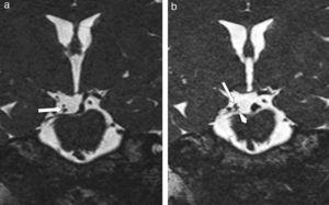 Brain MRI. a) Zoomed view of coronal slice: we observe oculomotor nerve (OMN) in contact with the right posterior cerebral artery (PCA). b) Zoomed coronal slice: OMN (arrowhead), PCA (arrow).