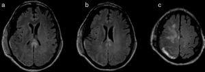Axial T2-weighted FLAIR MRI sequences. (a) and (b) Resection of the parenchyma of the right convexity and signal changes in the splenium of the corpus callosum. (c) Hyperintensities on the right superior area of the parietal cortex may indicate presence of blood and tissue damage associated with subdural haematoma.
