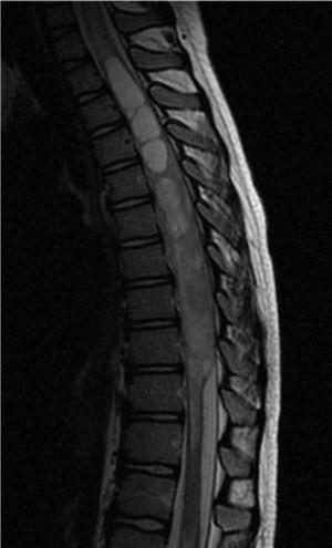 studie Kraniomedulární magnetické rezonance. Sagitální T2 vážená sekvence před podáním kontrastu vykazující intramedulární tumor od D5 do D9 a syringomyelii proximální k nádoru.