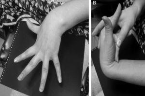 Patient with Ehler-Danlos syndrome type III. (A) Hyperextension of fingers and wrists. (B) The hypermobile middle finger can be pressed to the forearm.