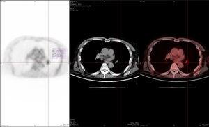 Whole-body 18F-FDG PET/CT study conducted one year after symptom onset, after our patient's second admission to hospital. Hypermetabolic mass in the root of the left lung with a maximum standardised uptake value (SUVmax) of 3.92 in the interlobar region (SUVmax≥2.5 generally indicates a high probability of malignancy), with normal findings on IV contrast CT images. Suspicion of adenopathy was later confirmed with an endobronchial ultrasound-guided puncture in the hypermetabolic region, which detected no neoplasia.