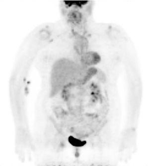 18F-FDG PET/CT scan showing diffuse hypermetabolism in the thoracic aorta, supra-aortic vessels, and abdominal aorta.
