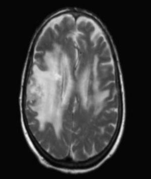 Brain MRI T2-weighted sequence. Hyperintense lesions on the right temporoparietal area and the left temporal area with associated vasogenic oedema.