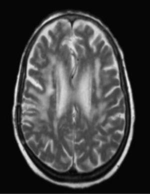 Brain MRI. T2-weighted sequence. Significant decreases in the volumes of lesions and associated oedemas after 4 months of CTx treatment.