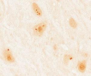 Immunohistochemical study of rat cerebellum incubated with serum from a patient with anti-Ma2 antibodies using the immunoperoxidase technique with avidin-biotin-peroxidase complex. We observed reactivity in the shape of large intracytoplasmic dots in neurons of the dentate nucleus.