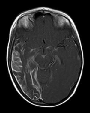 T1-weighted brain MRI with contrast showing leptomeningeal angiomatosis with secondary atrophy in the right occipitotemporal area.