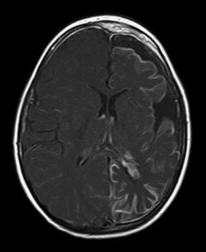 T1-weighted brain MRI with contrast showing leptomeningeal angiomatosis with atrophy in the left hemisphere.