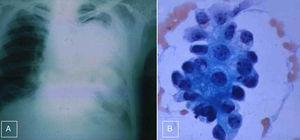 (A) Simple chest radiography showing a large radiopaque mass on the left hemithorax, very close to the mediastinum. No pleural effusion was found. (B) Mesothelioma with typical cells and fibrosis (haematoxylin and eosin stain ×1000).