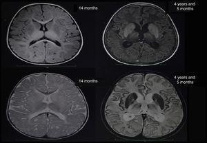 Comparative findings from nuclear MRI at age 14 months and at 4 years and 5 months.