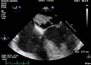 Transoesophageal echocardiogram: a heterogeneous, irregular, mobile mass attached to the interatrial septum by a broad stalk and with diastolic prolapse into the ventricle can be observed in the left atrium. The lesion is compatible with atrial myxoma.