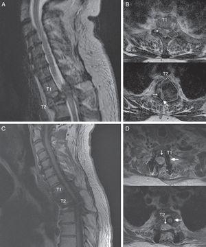 Spinal MR images of the patient. (A) Sagittal section of the cervicodorsal spine, showing the tumour invading vertebra T2. (B) Axial sections of the T1 and T2 vertebrae, showing the tumour (outlines), the significant rightward displacement of the spinal cord (small arrow), and the reduced subarachnoid space (large arrow), demonstrating the severe compression of the spinal cord. (C) MRI of the cervicodorsal spine showing the release of the spinal canal where it was previously affected by the tumour. (D) Axial sections of the T1 and T2 vertebrae showing the release of the spinal canal (small arrow) and the complete resection of the lesion and placement of material for fixation and stabilisation (large arrow).