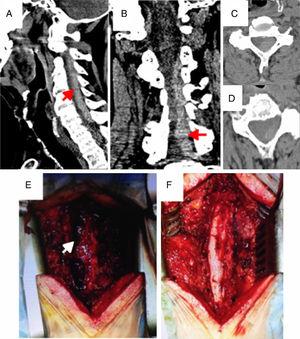 Presurgical images from the emergency cervical CT scan. Sagittal (A), coronal (B), and axial (C and D) slices revealing the presence of an extensive hyperdense collection at the left posterolateral epidural level C3-C7 (arrows), compatible with SAEH. This collection causes a pronounced reduction of the spinal canal and displacement of the spinal cord to the right. Images after C3-C7 cervical laminectomy showing the previously described acute cervical epidural collection at the left posterolateral level (E). Image during surgery after complete evacuation of SAEH (F).