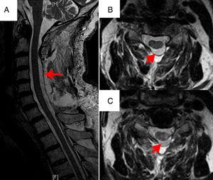 Cervical MRI scan performed 24 hours after surgery. Sagittal (A) and axial (B and C) slices showing adequate decompression of the spinal canal at vertebrae C3-C7 (arrows), with no sign of new blood collections or myelopathy at that level.