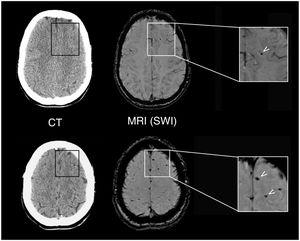 Neuroradiological findings in a 26-year-old patient with mTBI. The results of a brain CT scan (left) performed 2h after the trauma were normal, whereas a brain MRI study at 10 days (right) revealed focal signal alterations (arrows) on SWI sequences, which corresponded to microbleeds indicative of mild DAI.
