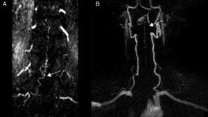 TRICKS MRI sequences showing the exact location of the fistula. (A) Right-sided spinal dural AVF at the L2 level (patient 10). (B) Spinal dural AVF at the C1 level (patient 3).