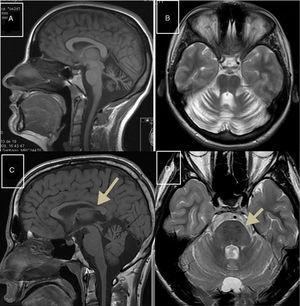 MR images. A) Sagittal T1-weighted sequence showing marked atrophy of the cerebellar vermis in a patient with ARCA1. B) Axial T2-weighted sequence showing pancerebellar atrophy in a patient with ARCA1. C) Axial T1-weighted sequence showing atrophy of the posterior part of the corpus callosum in a patient with ARSACS. D) Axial T2-weighted sequence showing linear hypointensities in the pons of a patient with ARSACS.