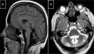 MR images from a patient with Marinesco-Sjögren syndrome. A) Sagittal T1-weighted sequence showing atrophy of the brainstem and cerebellar vermis. B) Axial T2-weighted sequence showing atrophy of the pons, vermis, and both cerebellar hemispheres, with no intraparenchymal signal alterations.