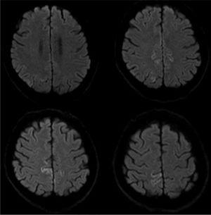 MRI scan at admission. Axial diffusion-weighted sequence showing abnormal cortical diffusion restriction in the precuneus bilaterally (particularly on the right) and in the right superior parietal lobule at the parasagittal level.