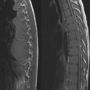 Reversible Paraparesis Secondary To Spinal Cord Compression In A ...