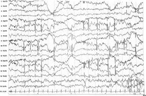 Video-EEG recording revealing epileptiform activity, frequently independent and in the centrotemporal region of both hemispheres, becoming more marked when the patient fell asleep and during non-REM sleep, with high persistence. Centrotemporal epileptiform activity is mixed with slow, irregular activity. Sensitivity: 15μV/mm; high-frequency filter: 70Hz; time constant: 0.3s.