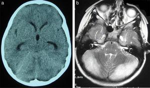 (a) Scansione TC cranica del paziente 2. Leggera dilatazione delle corna temporali e del terzo ventricolo, che appare più arrotondato del normale. Compressione delle strutture della fossa posteriore; il quarto ventricolo non è visibile. (b) Assiale T2-ponderata cervello MRI sequenza dal paziente 2. Iperintensità della materia grigia in entrambi gli emisferi cerebellari.