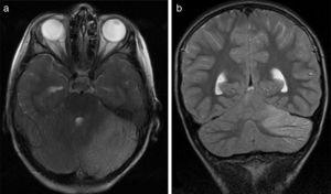 (a) ressonância magnética cerebral Axial T2 do doente 6. Sinal de hiperintensidade no córtex cerebelar esquerdo. Hemicerebellite. b) ressonância magnética ao cérebro, ponderada pelo T2 Coronal, do doente 6. Hiperintensidades afetam exclusivamente o córtex cerebelar esquerdo; não se observam hiperintensidades de matéria branca.