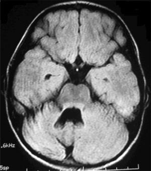 axiale FLAIR brain MRI scan van patiënt 1. De 15 maanden follow-up MRI studie toont atrofie van de rechter cerebellaire hemisfeer.