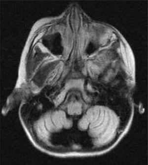 Axial FLAIR cérebro ressonância magnética do paciente 3. O estudo de ressonância magnética de 32 meses revela atrofia cerebelar.