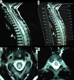MR images of the cervical and thoracic spine. (A) Sagittal T2-weighted sequence showing hyperintense lesions affecting the C1-C4 and T2-T4 regions. (B) Reference image for axial slices. (C) Axial T2-weighted sequence (slice 21) showing a hyperintense lesion predominantly affecting posterolateral regions of the spinal cord. (D) Axial T2-weighted sequence (slice 11) revealing a centrospinal hyperintense lesion.