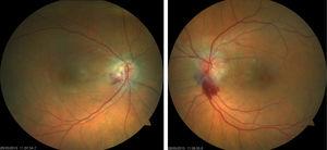 Diffuse oedema in both optic discs, peripapillary haemorrhage, and choroidal folds predominantly in the left eye.
