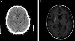(A) Brain CT revealing hyperdensity of the right basal ganglia. (B) T1-weighted brain MRI sequence showing hyperintensity of the right basal ganglia.