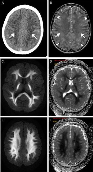 Report of a case of delayed posthypoxic leukoencephalopathy: a peculiar ...