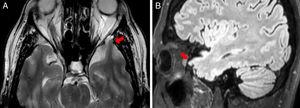 MRI scan: axial T2-weighted (A) and sagittal T2-weighted FLAIR sequences (B), showing a small herniation of the brain parenchyma in the anterior pole of the left temporal lobe through an anterior bone defect on the base of the cranium; this finding suggests encephalocele.