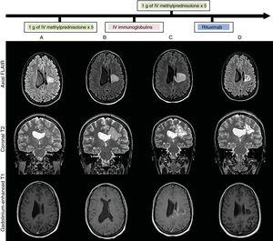 Brain MRI: lesion progression (FLAIR, T2-weighted, and gadolinium-enhanced T1-weighted sequences) at admission (A), after treatment with intravenous methylprednisolone (B), after treatment with intravenous immunoglobulins (C), and after treatment with rituximab (D). Heterogeneous lesion with grouped/confluent hypoechoic rims (A and B), progressing to cystic-malacic areas (C and D), affecting the left corona radiata and centrum semiovale with extension to the corpus callosum. Maximum diameter of 3cm at admission (A), increasing to 4.1cm despite treatment (C), and subsequently decreasing to 3cm after treatment with rituximab (D). No perilesional oedema or mass effect. No enhancement after contrast administration at admission (A), with subsequent intra-and perilesional patchy contrast uptake despite administration of corticosteroid and immunoglobulins (C); contrast uptake disappeared after treatment with rituximab (C).